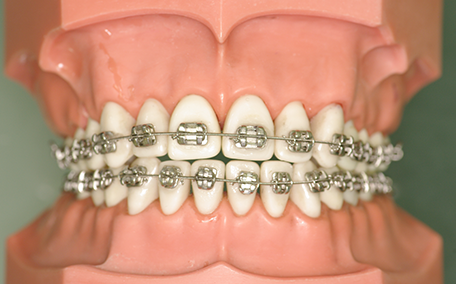 メタルブラケット装置