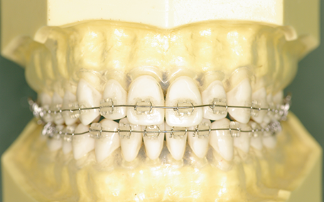 見えにくい矯正装置(セラミック、ブラスチックブラケット)
