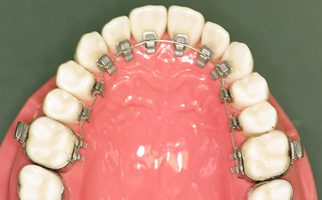 裏側からの矯正装置(リンガルブラケット装置)