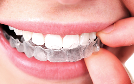 マウスピース型矯正装置