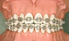 メタルブラケット装置