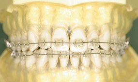 見えにくい矯正装置(セラミック、ブラスチックブラケット)