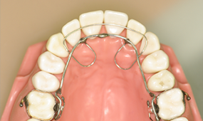 リンガルアーチ