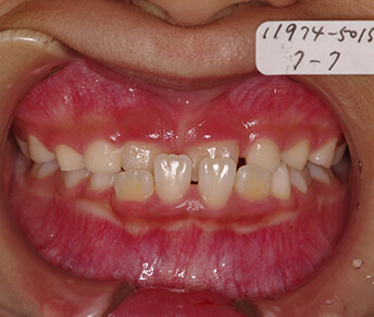 子供の矯正治療前の口内写真