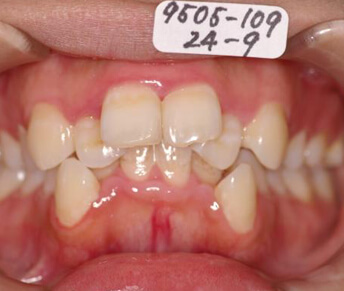 歯並び・咬み合わせ・八重歯・乱杭歯矯正治療前の口内写真