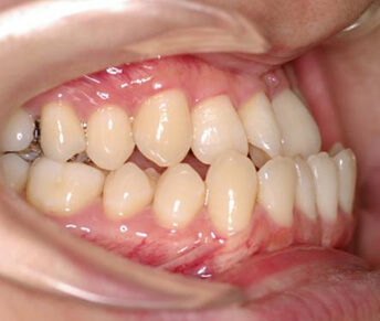 受け口矯正治療前の口内写真