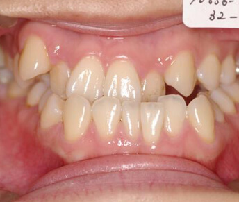 顎、顔の歪み矯正治療前の口内写真