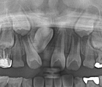 埋伏歯矯正治療前の口内写真
