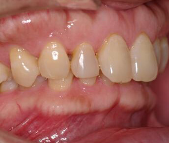 矯正治療前の口内写真