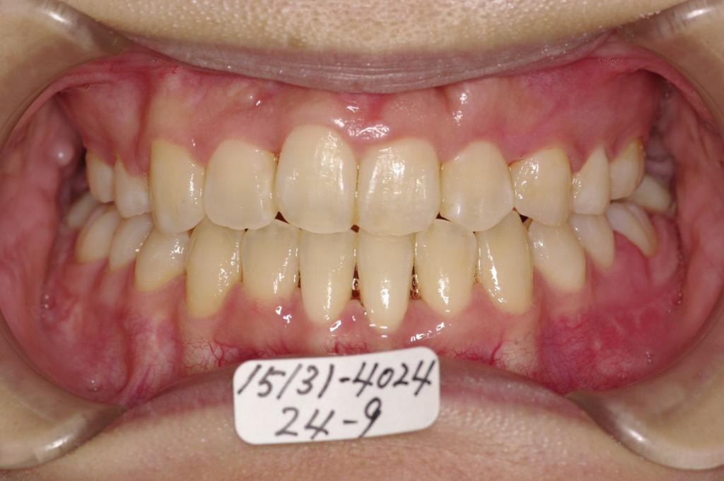 顎、顔の歪みの矯正治療後口内写真NO.414
